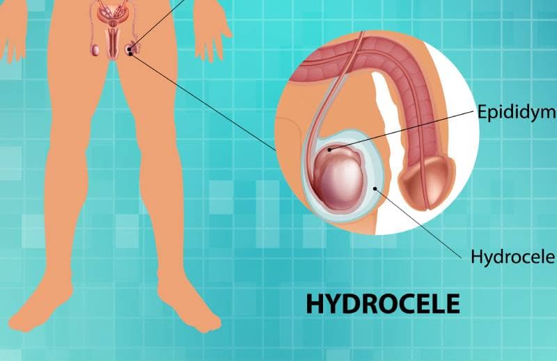 Descubre cómo el Dr. Juan Carlos Camacho Carvajal puede ayudarte  con problemas de Hidrocele 