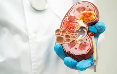 Cáncer de riñón